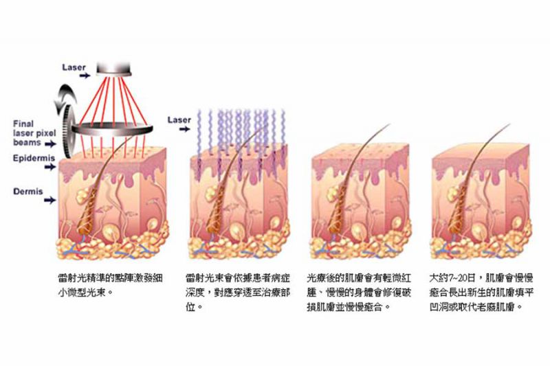 飞梭雷射（点阵激光）疗程中会疼痛吗?注意事项有哪些？