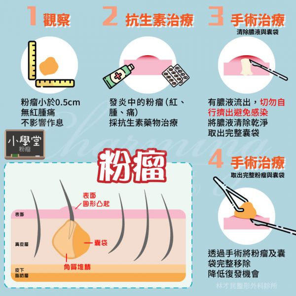 评美帮【小学堂】：常常误以为是粉刺的粉瘤 粉瘤怎么治疗？