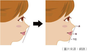 下巴的内缩及过短有哪些手术方式？隐藏式下巴整形和小伤口下巴整形