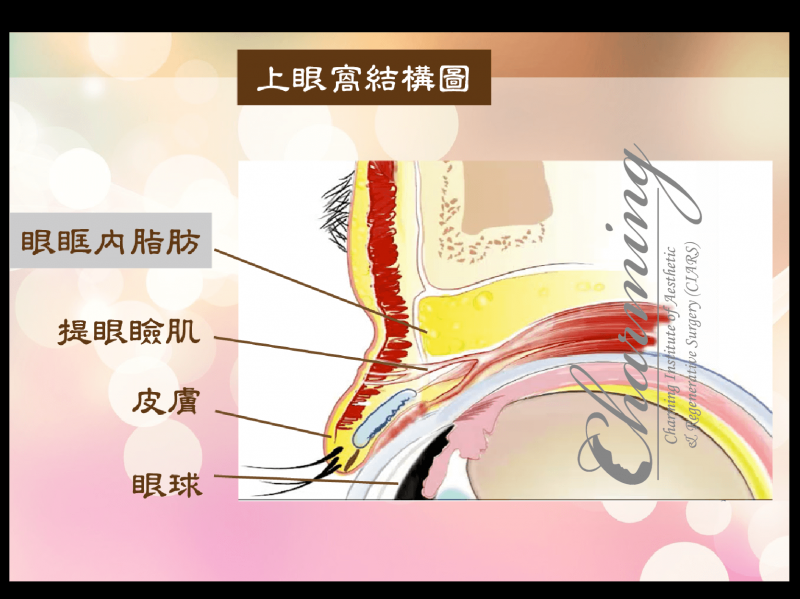 上眼窝凹陷怎么办？脂肪填充上眼窝效果好吗？