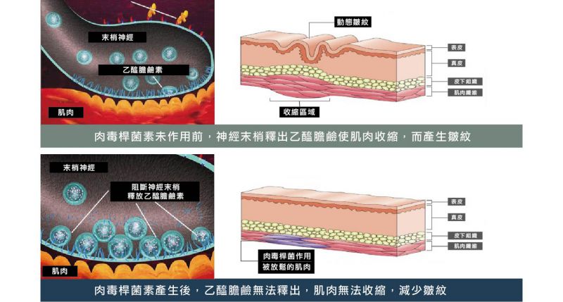 打肉毒杆菌脸会变得很不自然？肉毒素打一次有效果吗？