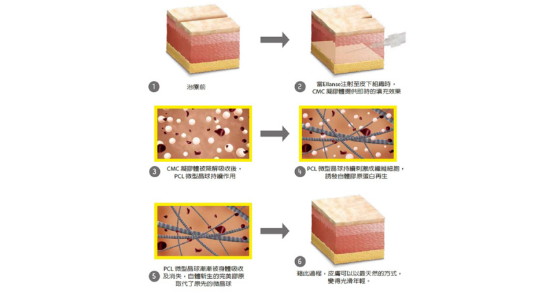 洢莲丝Ellanse依恋诗特色和适用对象有哪些？