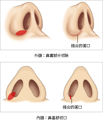 缩鼻翼手术可以做到无痕吗？隐痕鼻翼疗程的不同处和特点