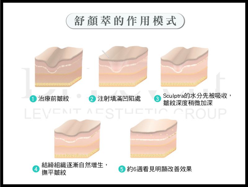 舒颜萃Sculptra对皱纹静态纹效果好吗？舒颜萃Sculptra术前注意事项