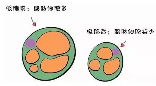 威塑脂雕抽脂效果怎么样？威塑?脂肪雕刻有哪些优点和特点？