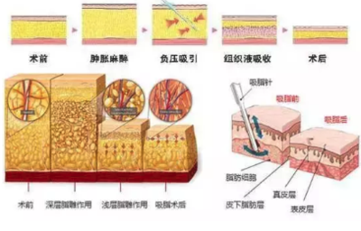 抽脂副作用有哪些？吸脂副作用有哪些？