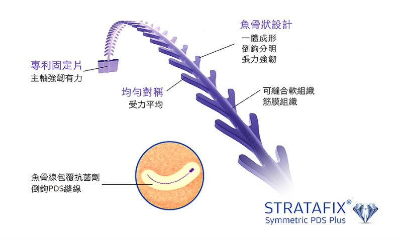 埋线是否有年龄限制？如何判断脸部是否适合埋线？埋线提升恢复期多久？