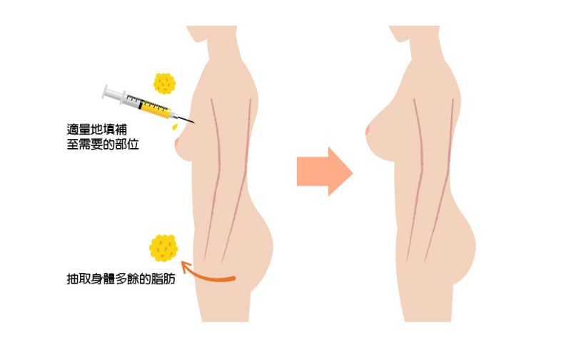 丰胸为什么选择自体脂肪移植手术？自体脂肪的好处是什么？