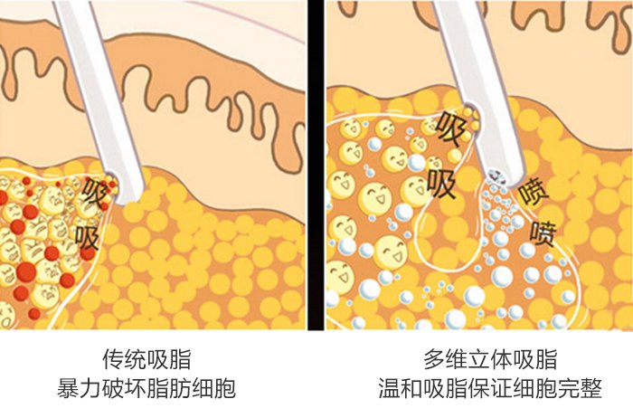 威塑VASER就算是减肥吗？威塑脂雕安全吗？威塑失败？需要住院吗？