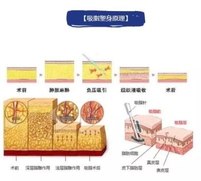 使用手术方式将脂肪移出的方法有哪些？脂肪移植（吸脂）