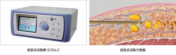 超音波溶脂原理是什么？超音波溶脂疗程主要特色有哪些？