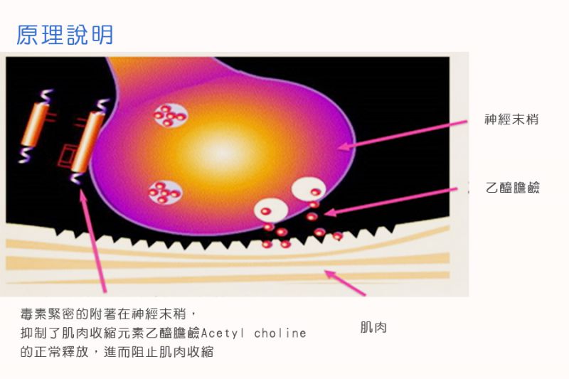 肉毒杆菌素适用对象有哪些？肉毒杆菌素治疗流程和注意事项？