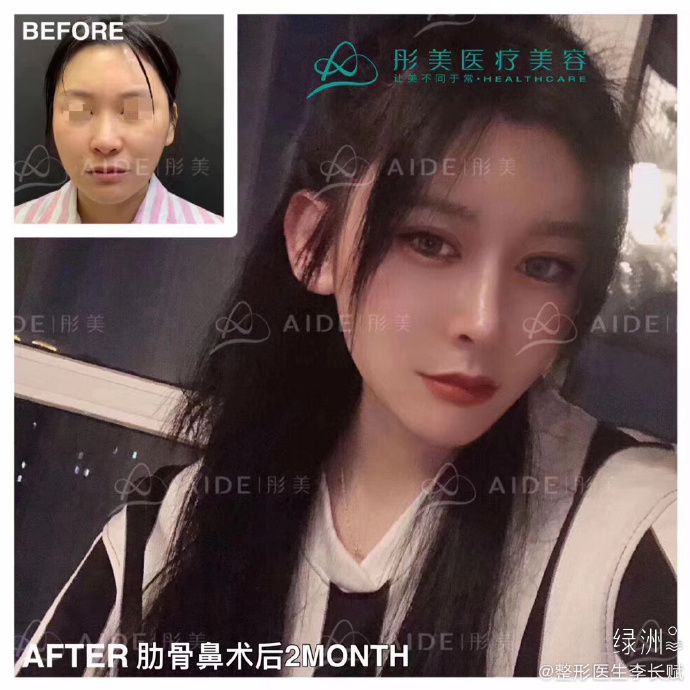 北京李长赋和李劲良哪位鼻子做的更好？