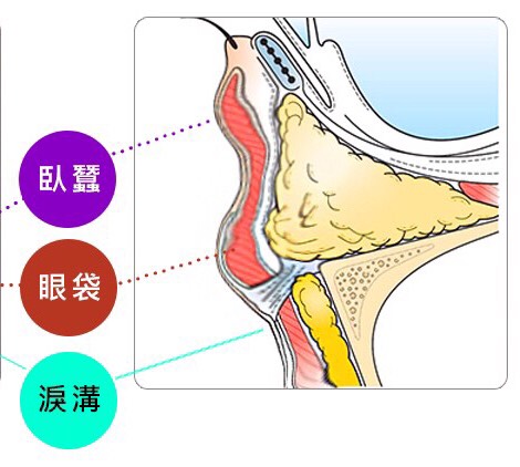 泪沟，眼袋，卧蚕，傻傻分不清楚？眼袋的手术方法是什么？