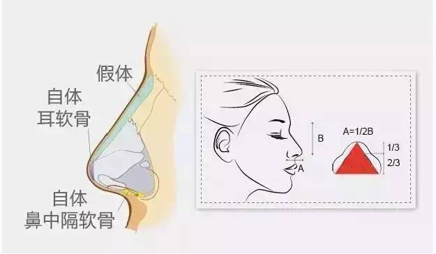 常见的隆鼻修复的类型有哪些？人工鼻模挛缩微整鼻变形都需要做修复吗？