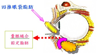 祛眼袋手术最有效的方式是什么？眼袋脂肪回推,眼袋不再复发