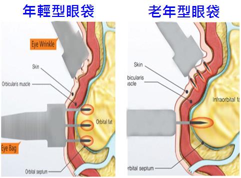 克文史森微针电波(集效电波)针对眼袋和眼周皱纹效果怎么样？