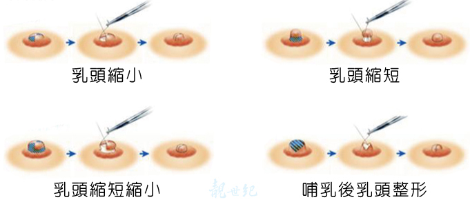 乳头内缩程度不一样怎么做乳头内陷矫正？