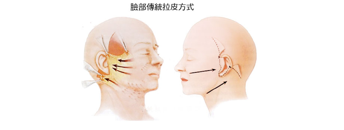 什么是拉皮手术？传统拉皮内窥镜拉皮适合对象有哪些？