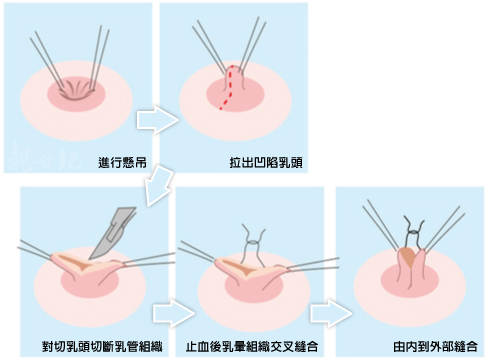 哪些人不能做乳晕乳头整形？乳晕乳头整形术前术后注意事项有哪些？