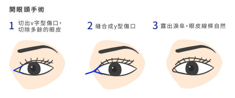 为什么需要开眼头手术（开眼角）？开眼头手术（开眼角）注意事项