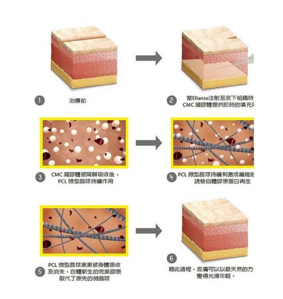 ELLANS?? 洢莲丝的作用原理是什么？少女针副作用注意事项有哪些？