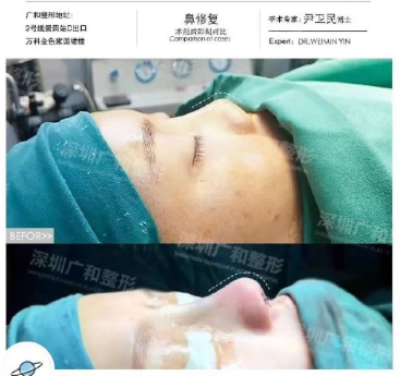 中国最有名的隆鼻整形医生有哪些？中国知名鼻综合医生排行榜