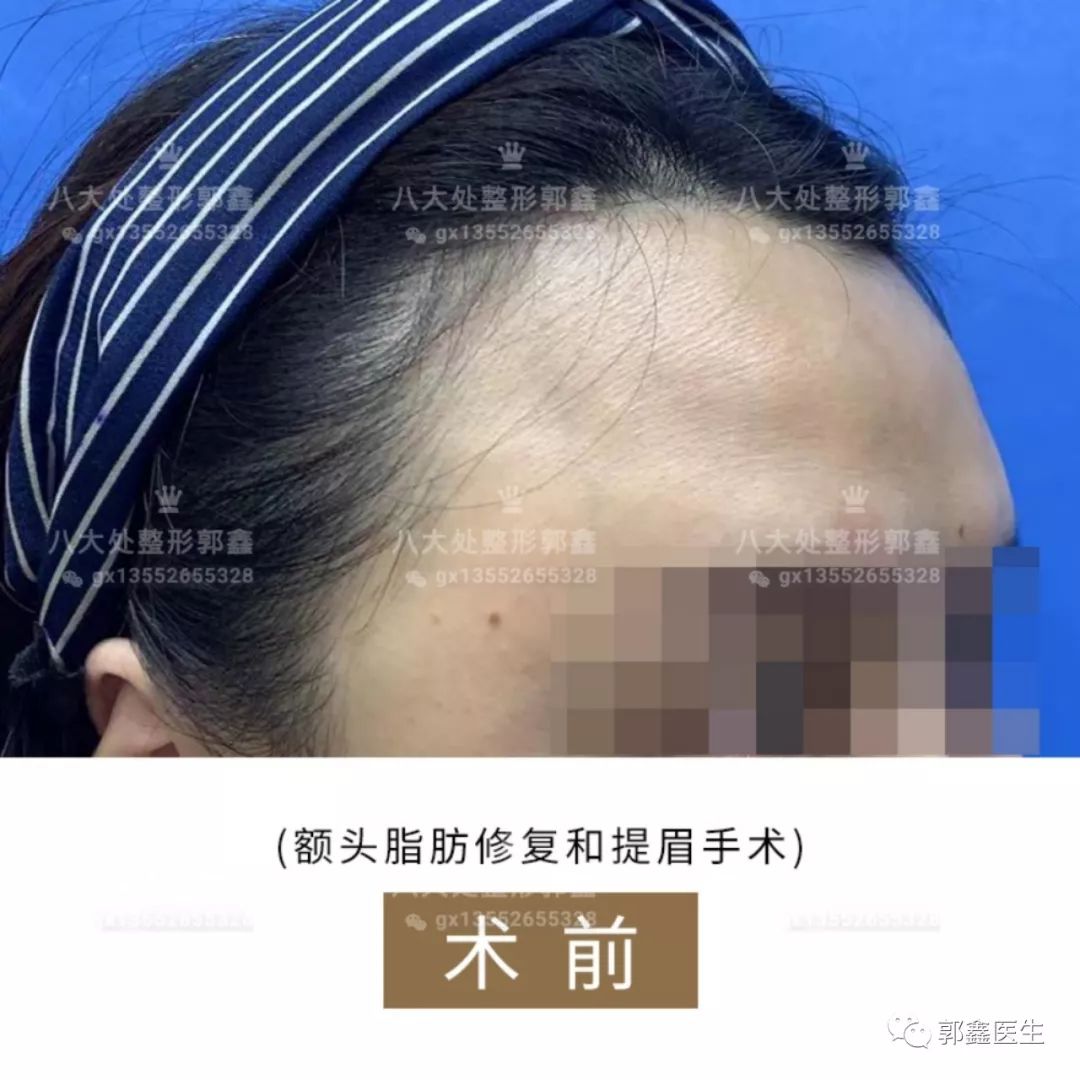 北京八大处脂肪修复专家:郭鑫马桂娥李发成顾云鹏做脂肪修复预约多少钱？