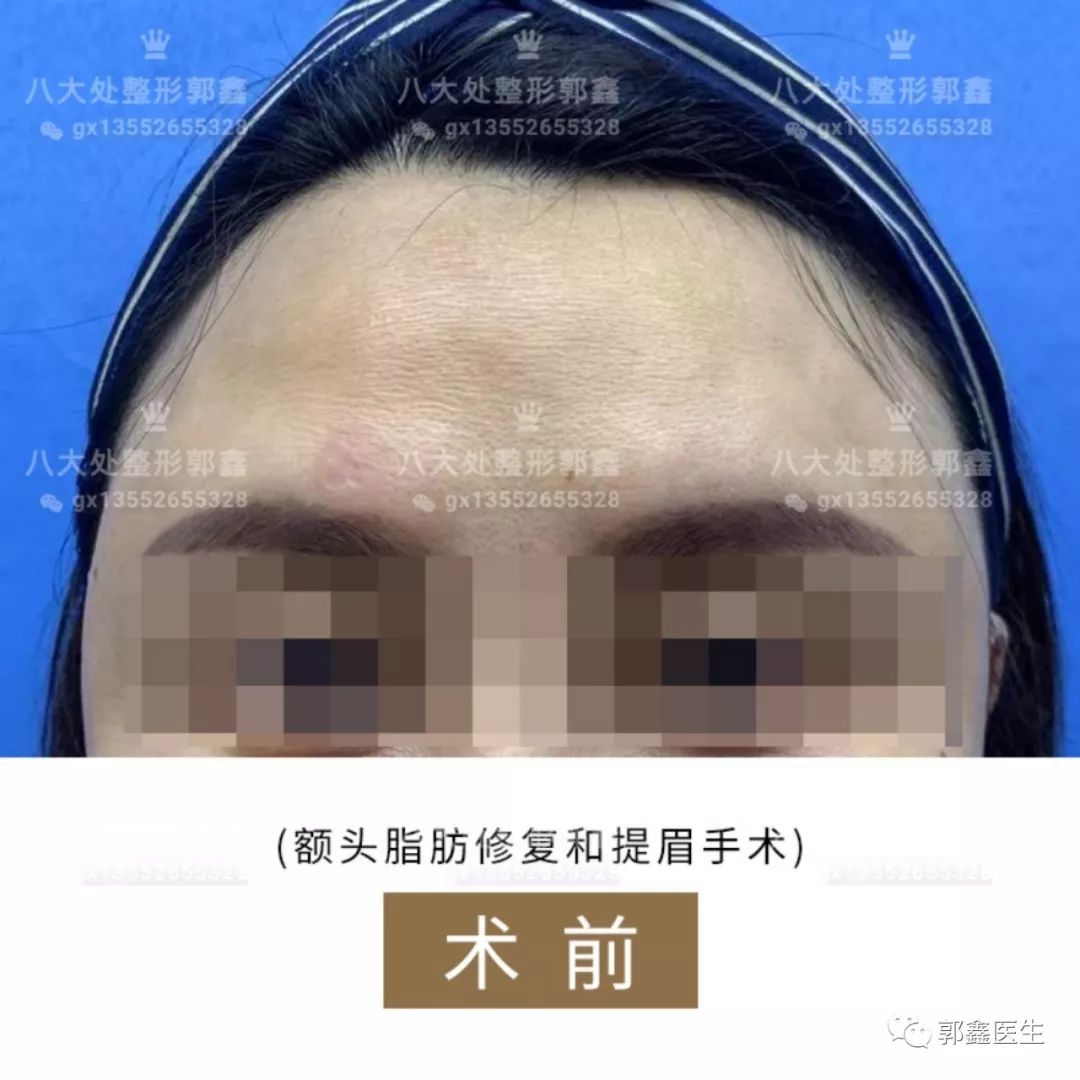 北京八大处脂肪修复专家:郭鑫马桂娥李发成顾云鹏做脂肪修复预约多少钱？