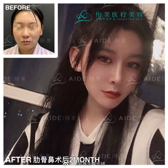 北京做鼻子做的好的医生:李长赋李劲良王军师俊莉刘暾鼻综合预约多少钱？