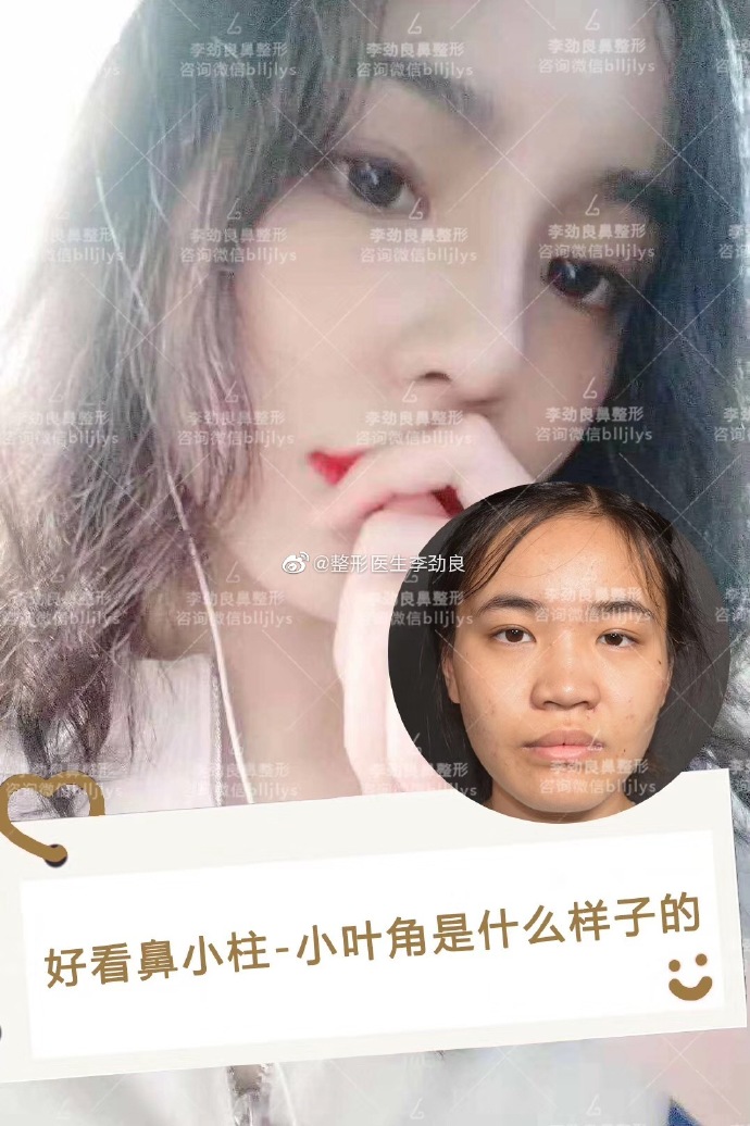 北京做鼻子做的好的医生:李长赋李劲良王军师俊莉刘暾鼻综合预约多少钱？