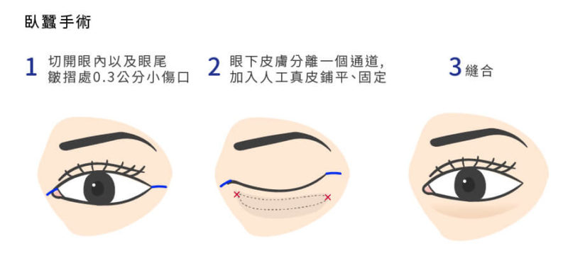 医美整形隆鼻有哪几种隆鼻方式？隆鼻术后多久才能消肿？