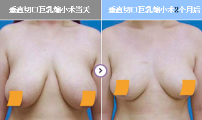 巨乳缩小麻醉方式需要睡眠全身麻醉吗？缩乳会影响哺乳吗？