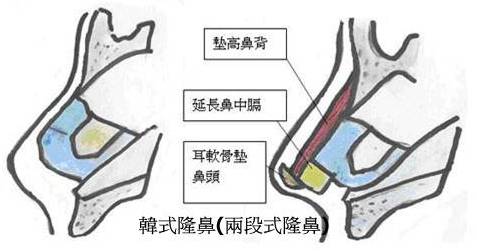 传统美式隆鼻有哪些缺点？韩国二段式隆鼻有什么优点？