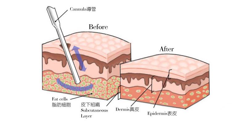 抽脂安全吗?抽脂需要住院吗?一次能抽多少?