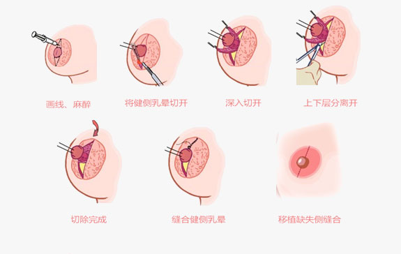 乳晕缩小和乳头缩小手术步骤是怎样的？乳头乳晕缩小手术注意事项