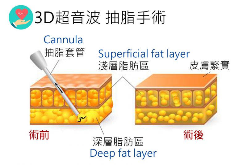 抽脂最多能抽多少CC？抽脂原则及禁忌有哪些？