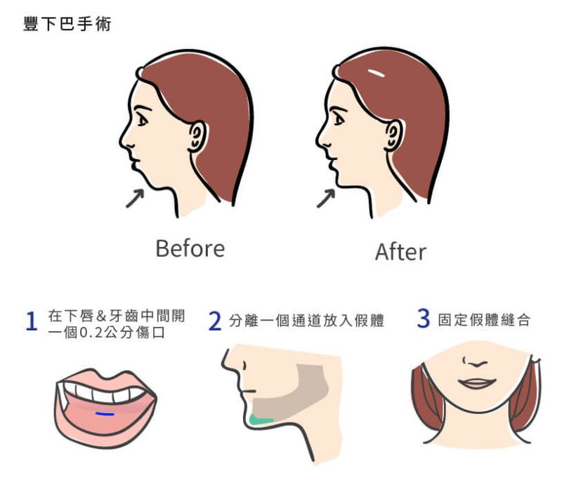 下巴整形手术方法有哪些？下巴整形手术后几天消肿？