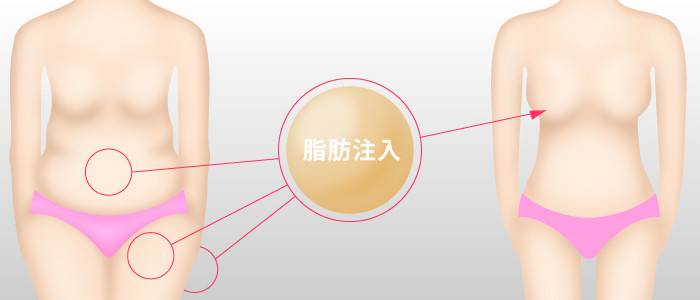 自体脂肪移植丰胸术后乳房和真的一样自然吗？丰胸后可以减肥吗？