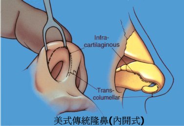 传统隆鼻方式有什么后遗症？传统隆鼻遇到条件差的鼻子，后患无穷