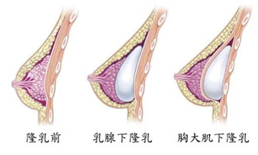 内视镜果冻隆胸手术术前术后注意事项有哪些？