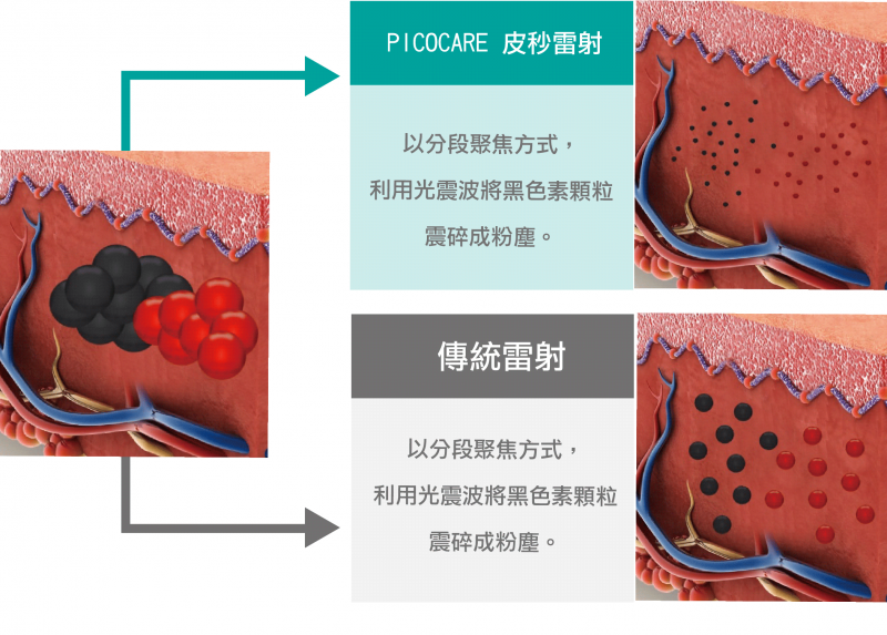 皮秒过程会不会很痛?需要上麻吗? 皮秒后会反黑吗？