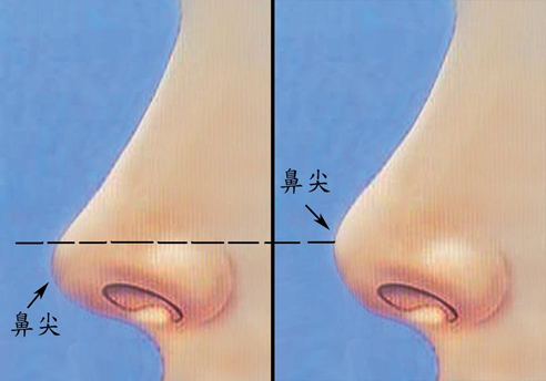 鼻整形等于隆鼻吗？传统隆鼻手术的缺点是什么？