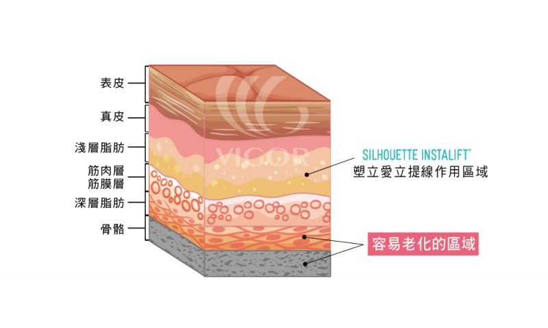 塑立爱立提线是属于哪种线雕呢？塑立爱立提线的特色优势？