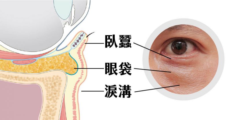 祛眼袋手术前注意事项有哪些？如何自然消除眼袋？