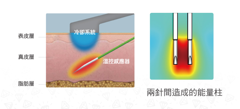 Profound 魔方电波除皱需要治疗几次？ 安全吗？