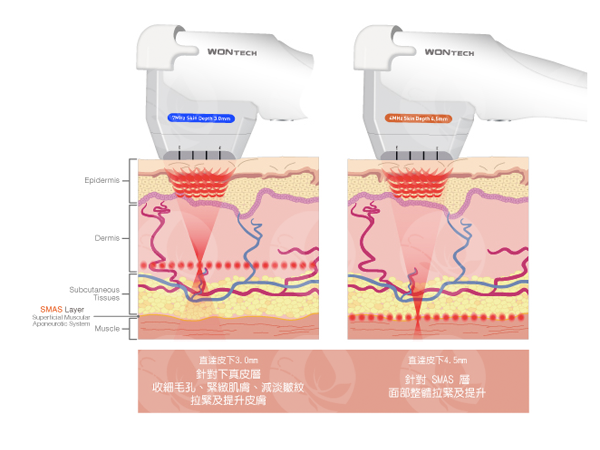 脸皮松弛有不开刀的解决方法吗？极限音波拉皮电波拉皮