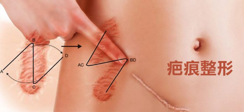 蟹足肿、疤痕增生有哪些治疗方法？