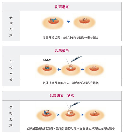 乳头异常乳头增生怎么办？乳头整形手术方式和并发症有哪些？