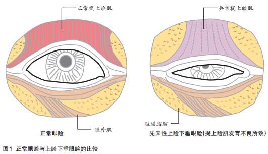 加菲猫眼怎么办？提眼睑肌手术效果怎么样？